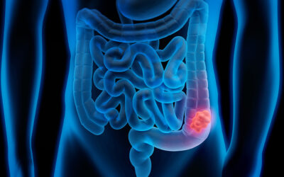 Día Mundial del Cáncer  Colorrectal