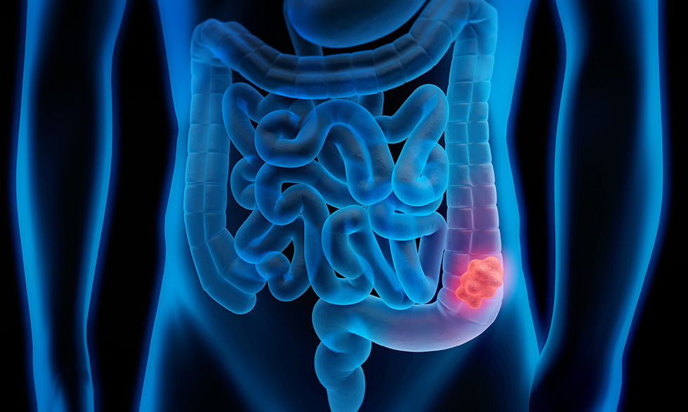 Día Mundial del Cáncer  Colorrectal